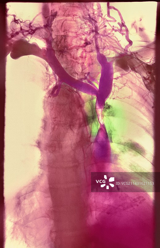 肺癌X光片图片素材