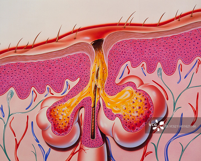 带有痤疮的皮肤截面艺术作品图片素材