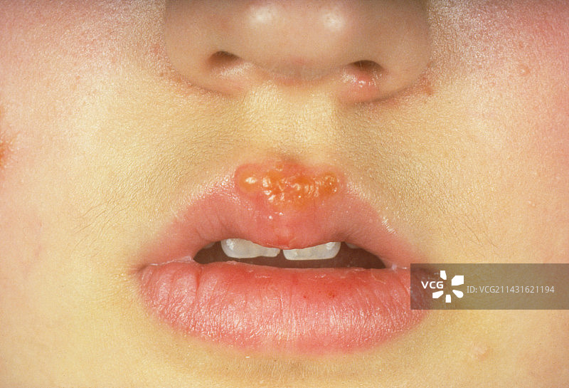 患有唇疱疹的女孩图片素材