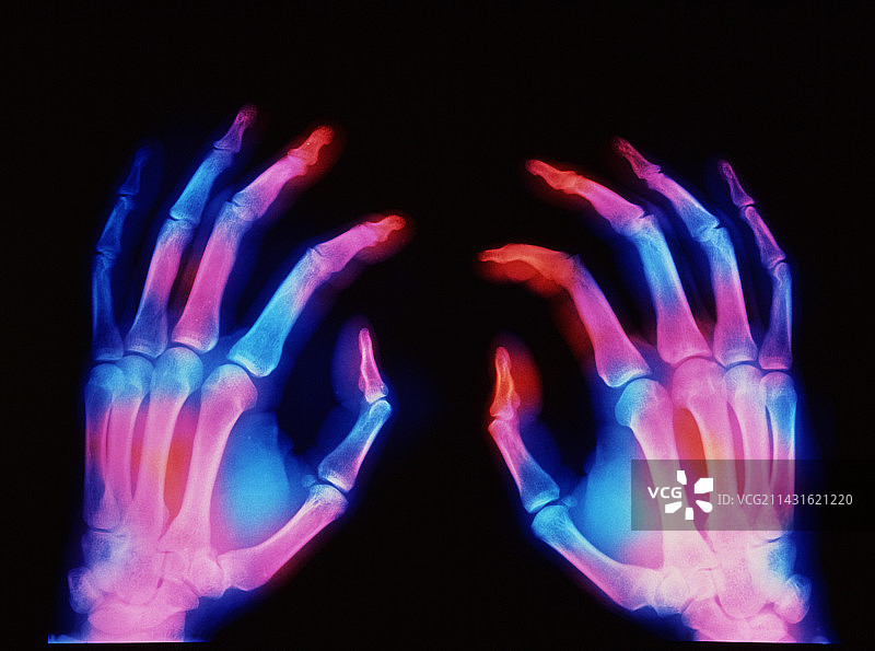 手部X光片图片素材