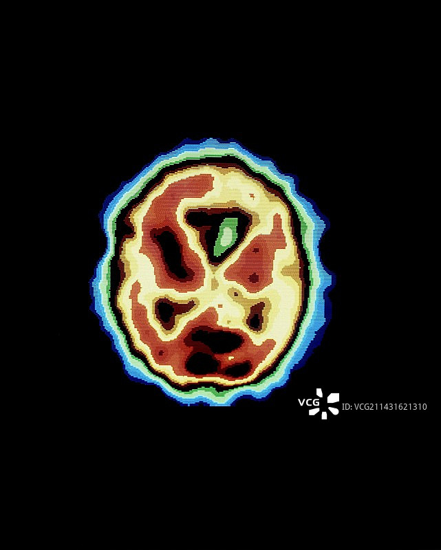 阿尔茨海默病的PET扫描图片素材