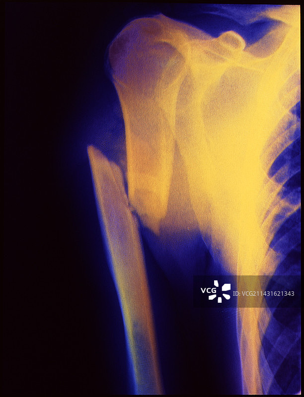 骨折的上臂骨图片素材