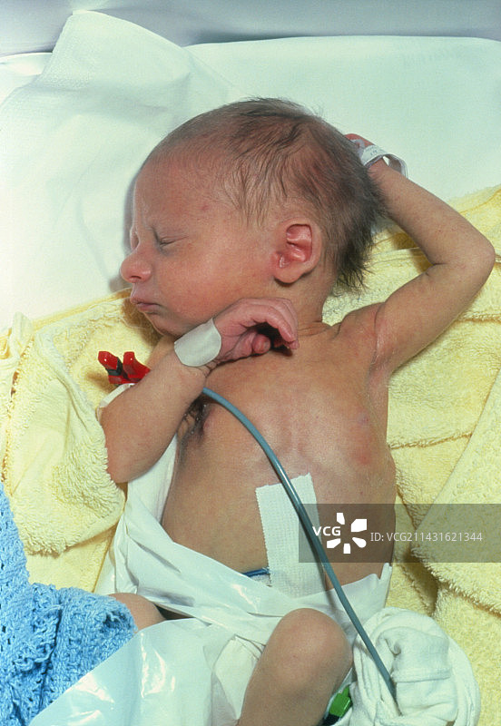 患有黄疸的新生婴儿图片素材