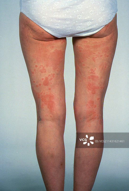 女性腿部背面的荨麻疹图片素材