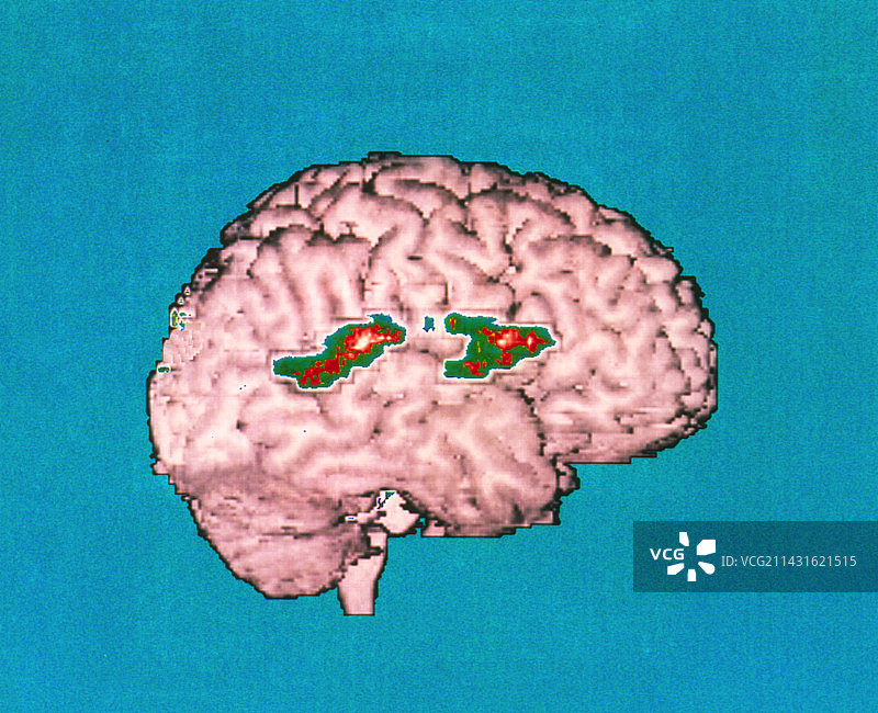 显示语言记忆区域的PET脑部扫描彩色图图片素材