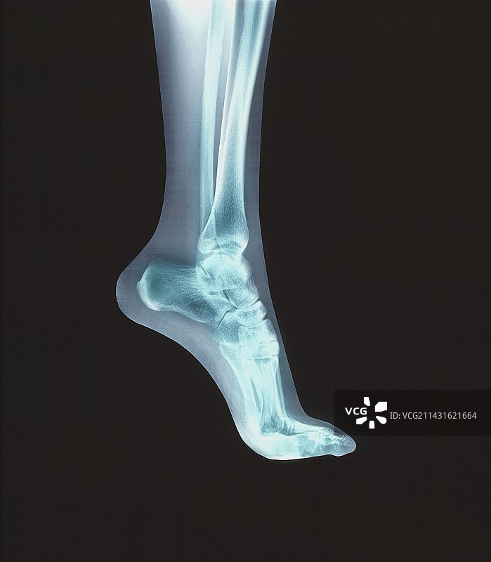 足部骨骼的彩色X光片图片素材