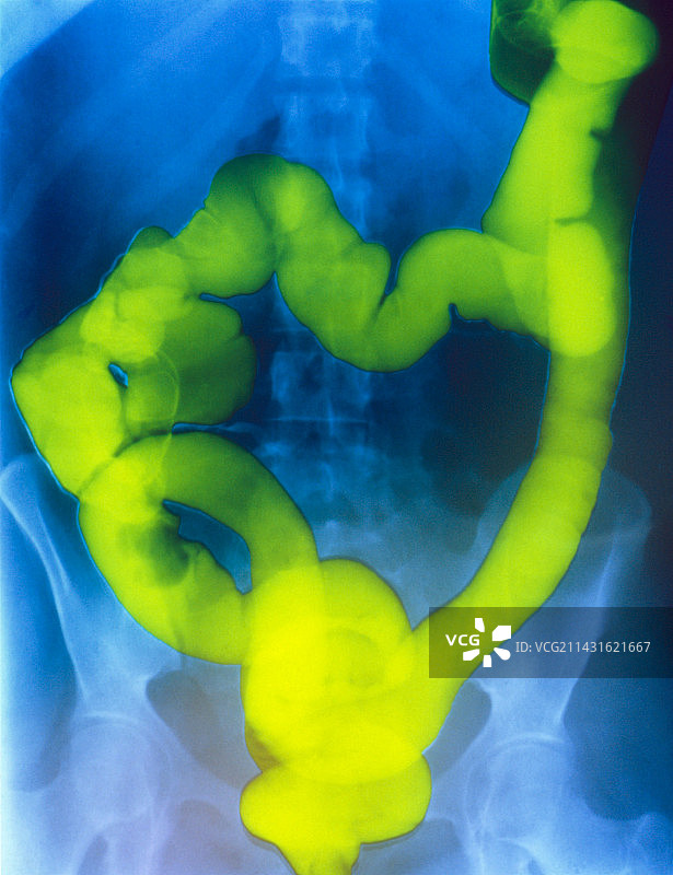 显示结肠癌的钡灌肠X光片图片素材