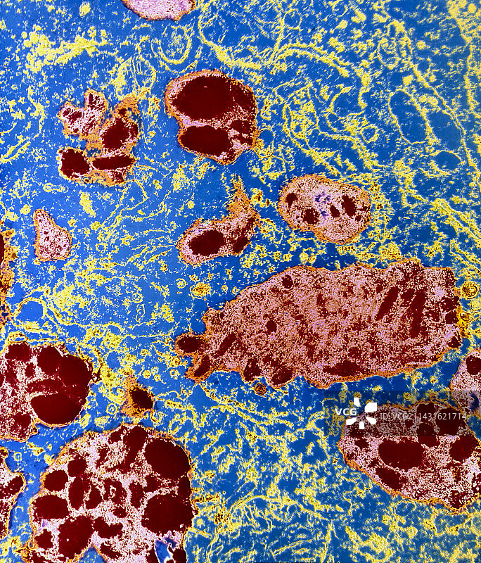 人黑色素瘤中黑色素生成彩色透射电镜图图片素材