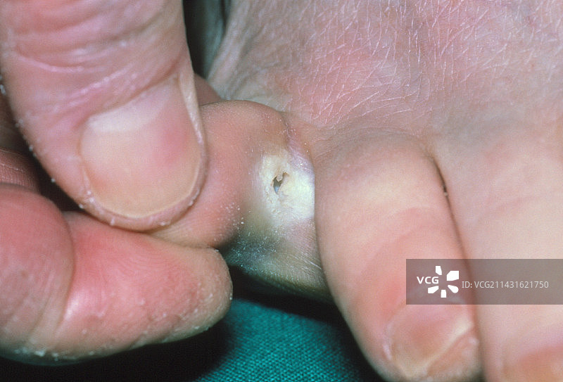 运动员足部特写：足癣感染图片素材