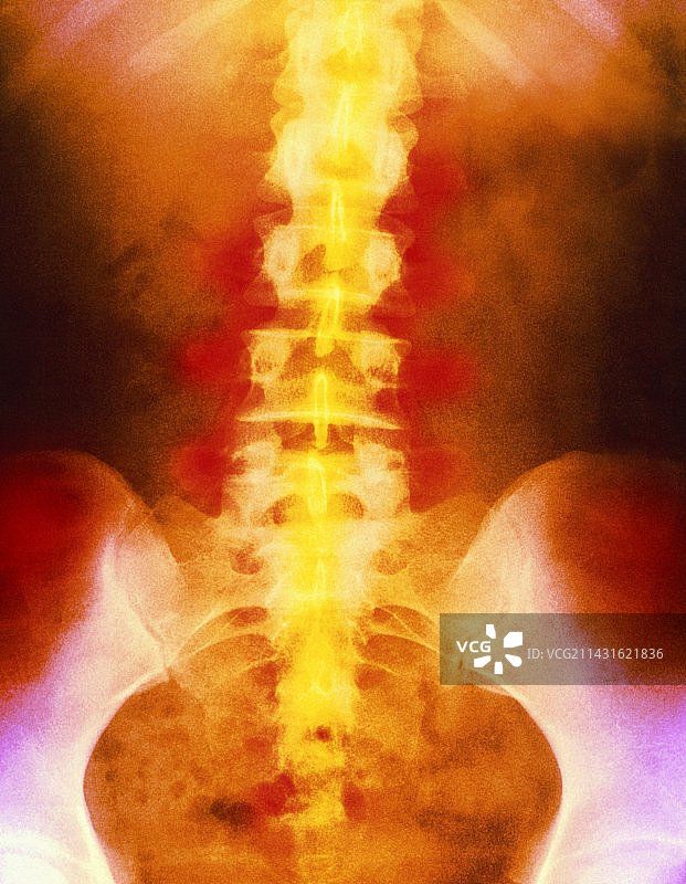 彩色x光片显示脊柱下部疼痛图片素材