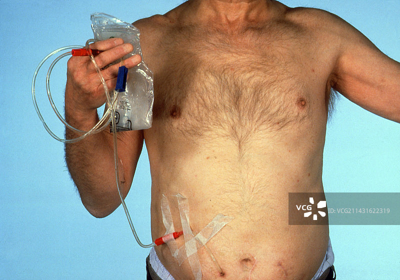 男子接受流动腹膜透析图片素材