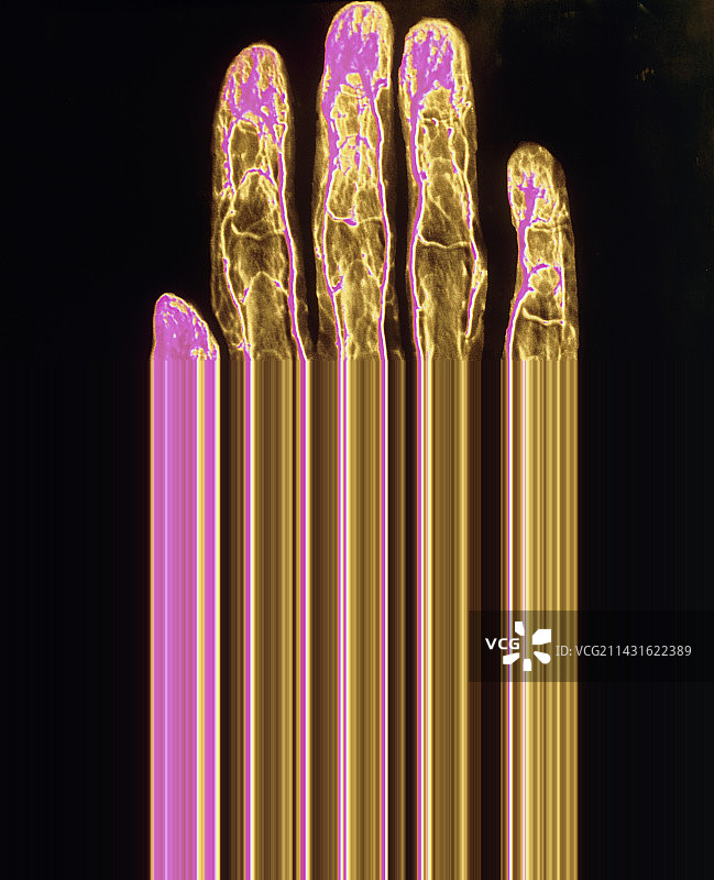 人手动脉血管造影图片素材