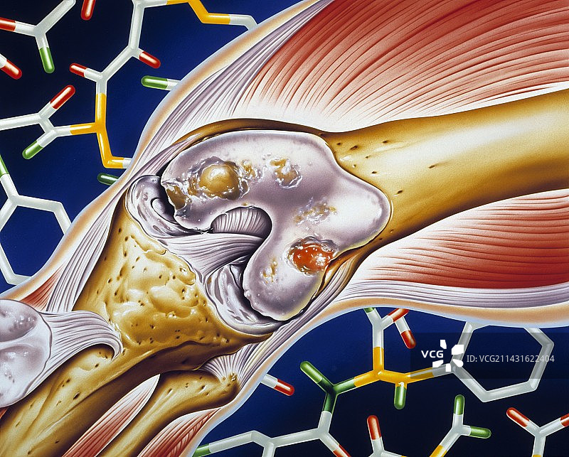 膝盖类风湿性关节炎图片素材