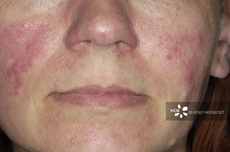面颊上的酒渣鼻痤疮图片素材
