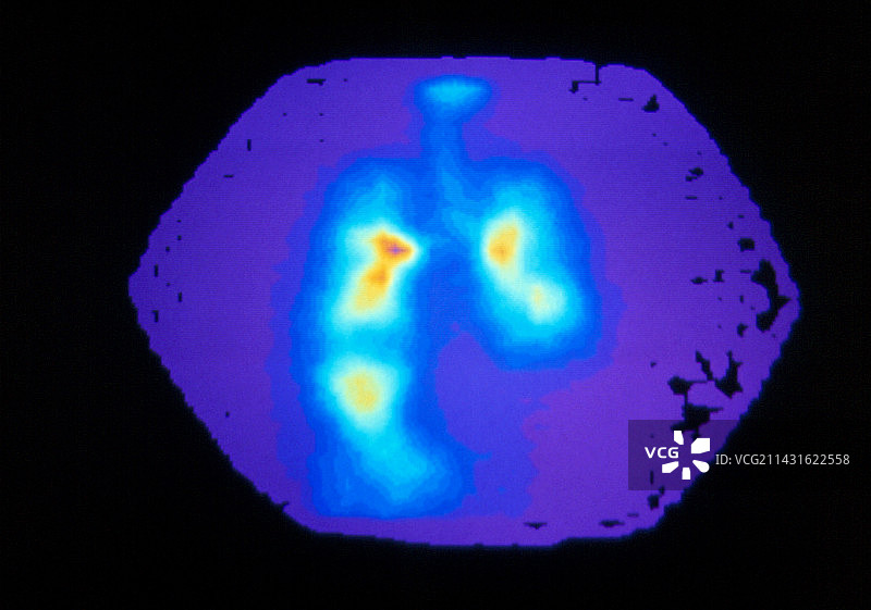 哮喘病人肺部彩色伽马扫描图片素材