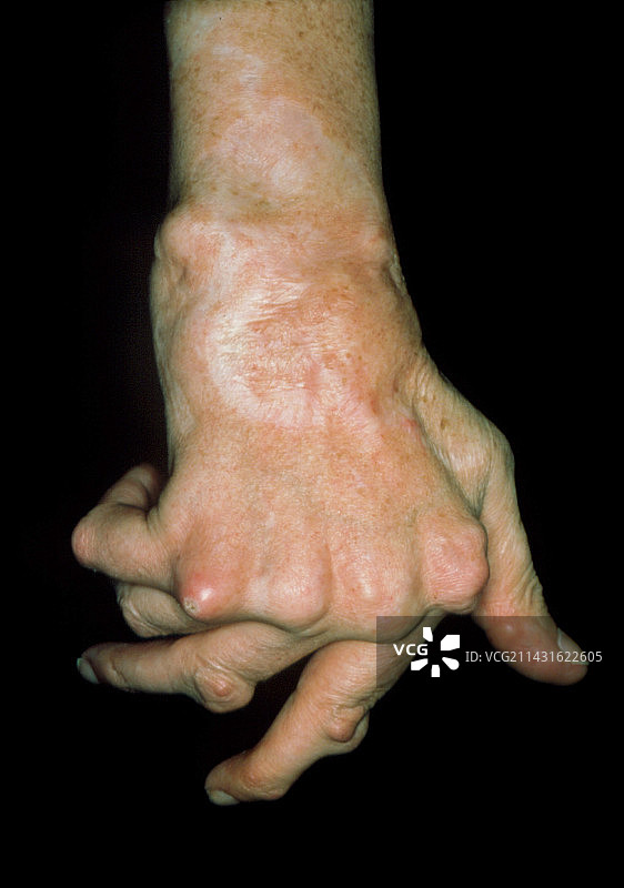 类风湿性关节炎图片素材