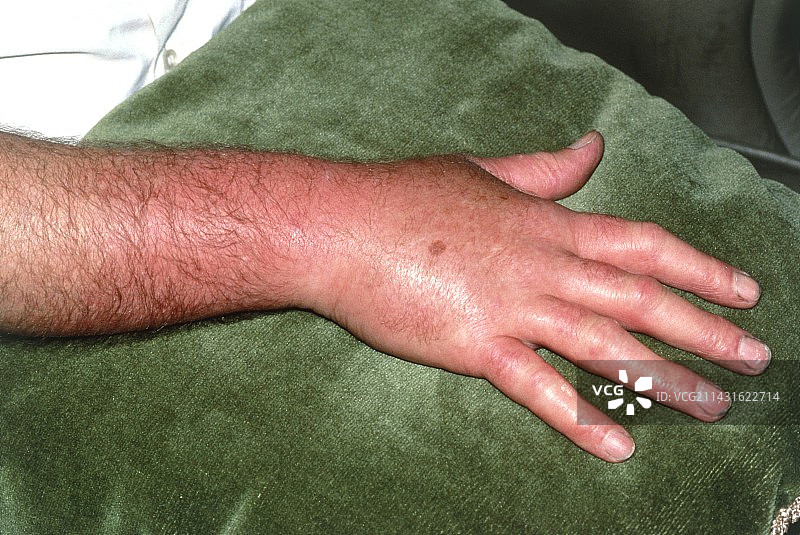 男子手上因蜂窝组织炎引起的炎症图片素材