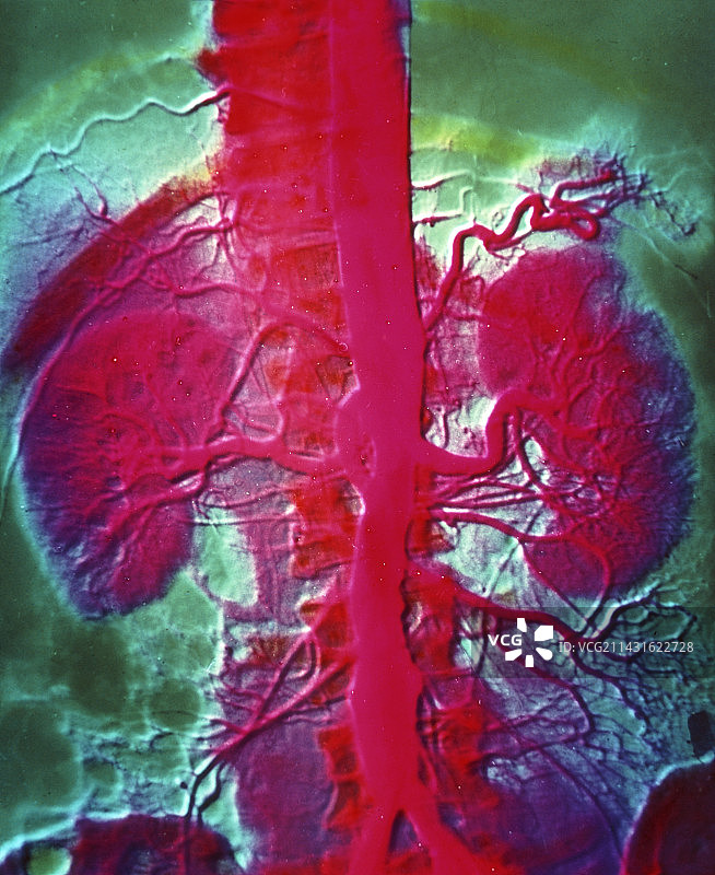 显示肾脏血液供应的血管造影图片素材