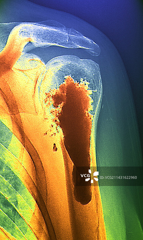 继发性骨癌X光片图片素材