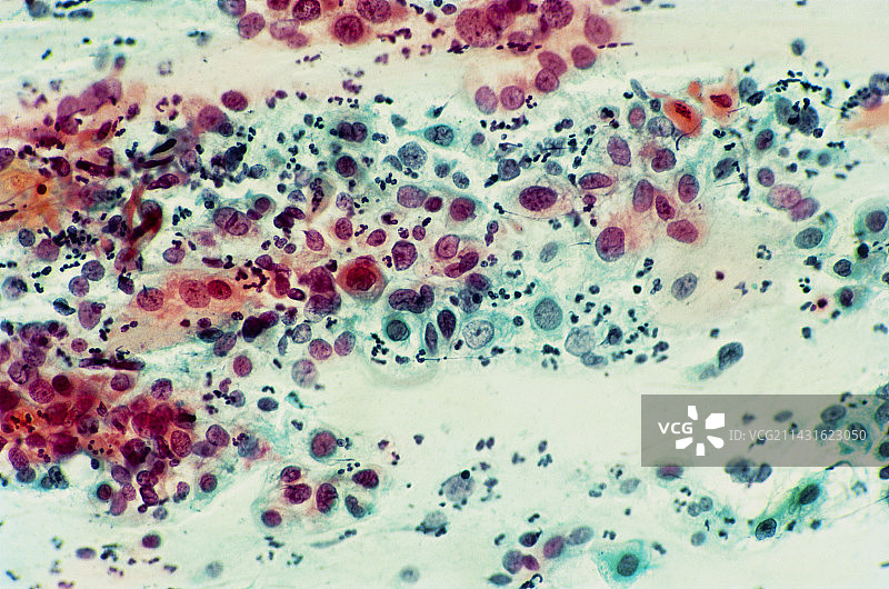 宫颈涂片中重度发育不良的显微照片图片素材