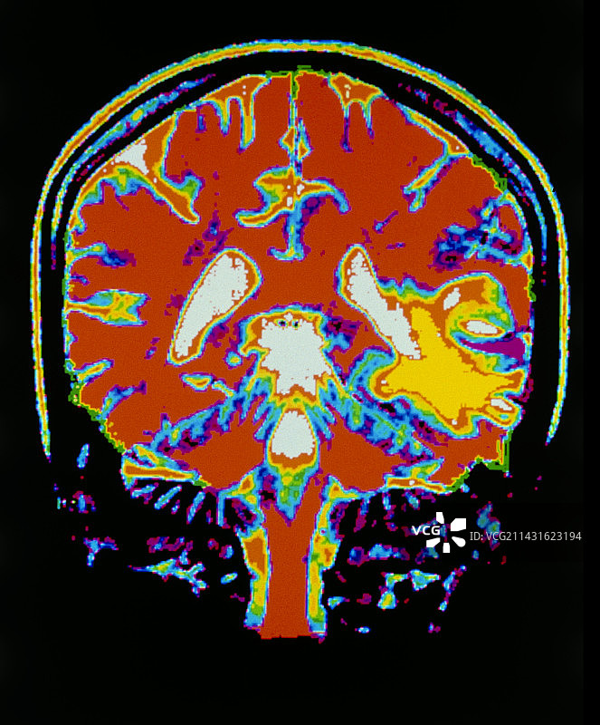 中风后的大脑MRI扫描图片素材