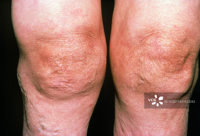 膝盖类风湿性关节炎图片素材