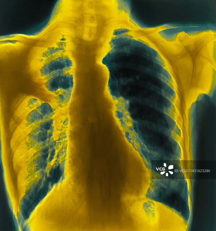 显示支原体肺炎的彩色胸部X光片图片素材