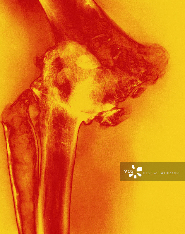 肘部类风湿性关节炎的彩色X光片图片素材