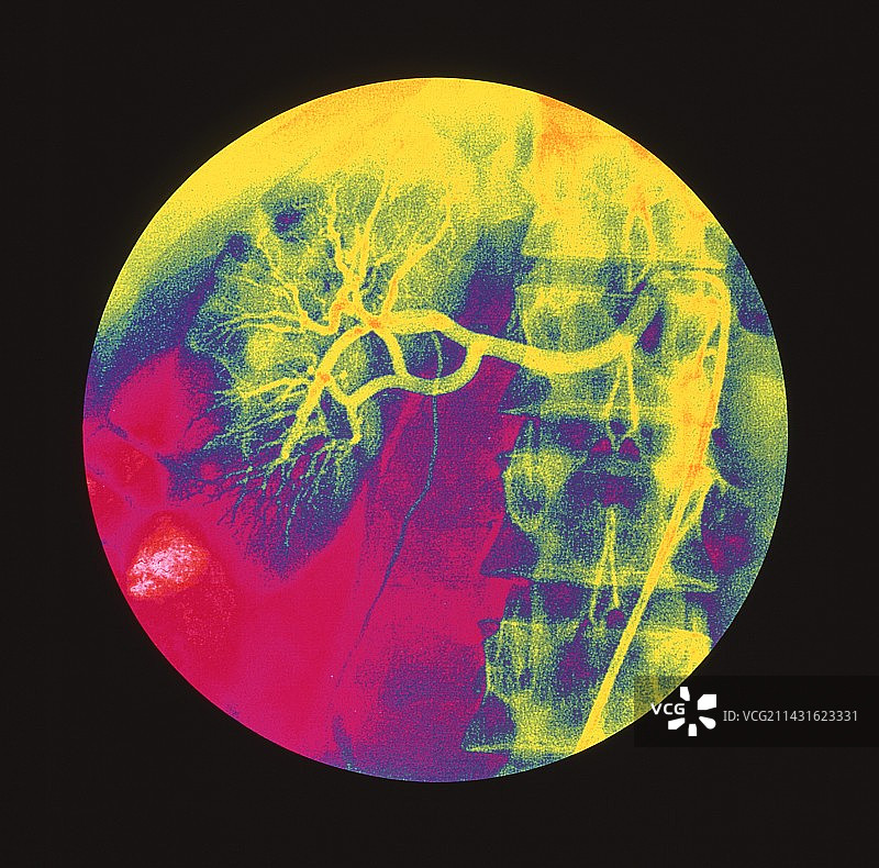 健康肾脏的彩色血管造影X光片图片素材