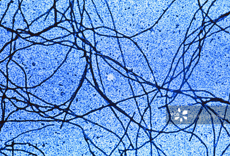 阿尔茨海默病中蛋白质丝的彩色透射电镜图图片素材