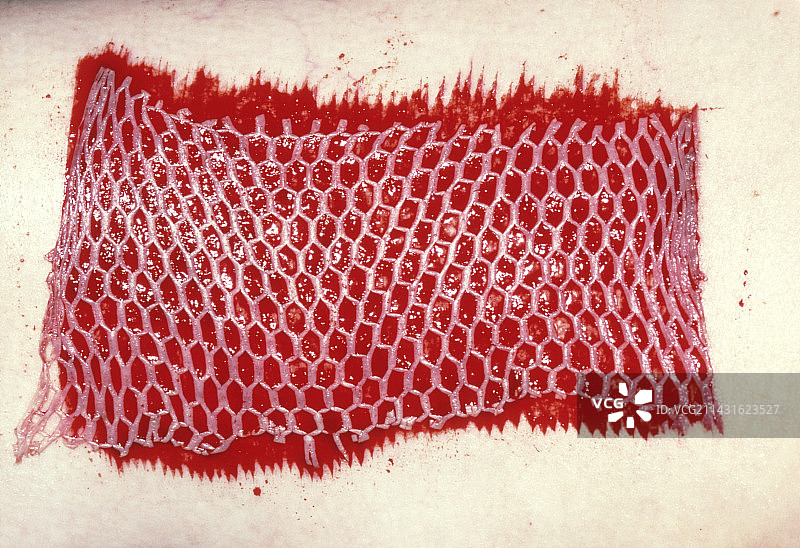 附着于烧伤的网状植皮图片素材