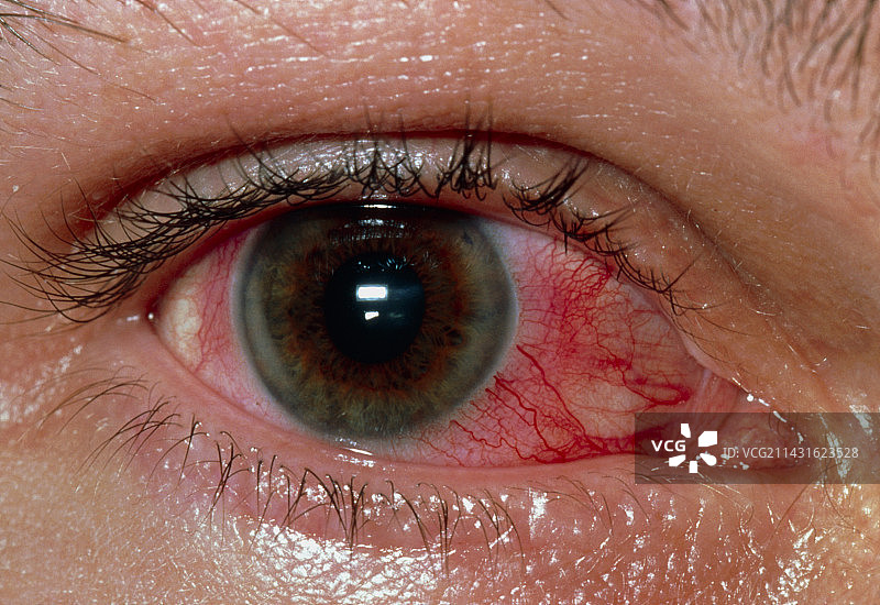 患有表层巩膜炎的眼睛特写图片素材