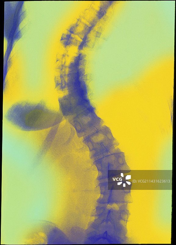 脊柱侧弯彩色X光片图片素材