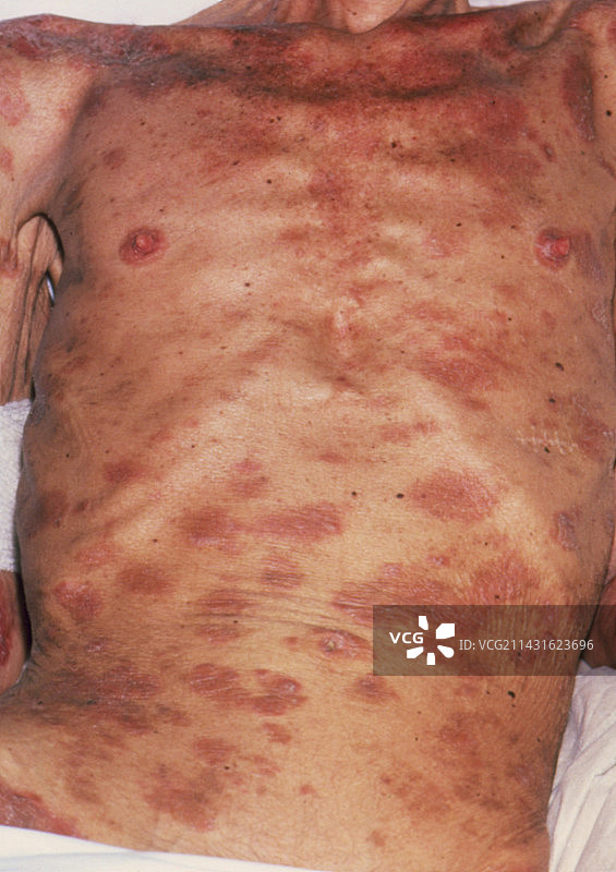 因艾滋病引起的脂溢性皮炎和消瘦图片素材