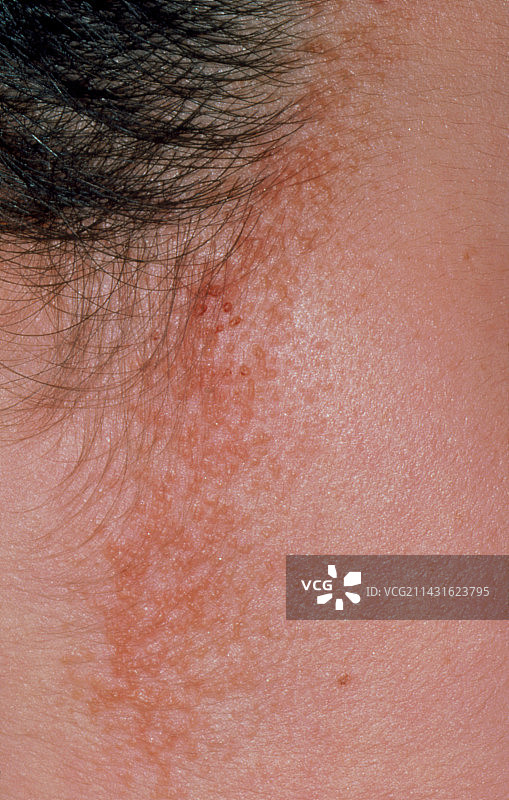 发际线周围的脂溢性皮炎图片素材