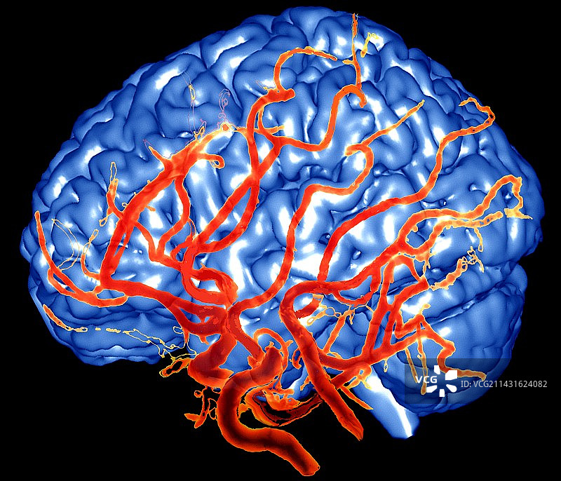 大脑和动脉，3-D MRA扫描图片素材