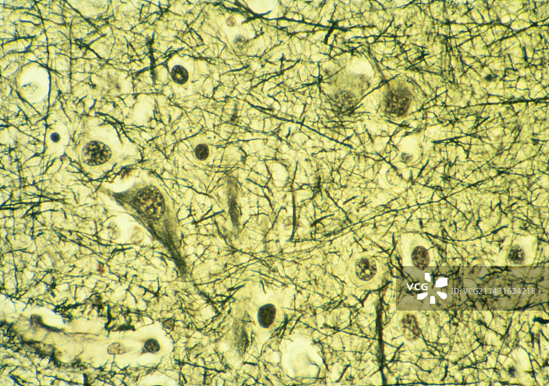 阿尔茨海默病患者大脑的显微照片图片素材