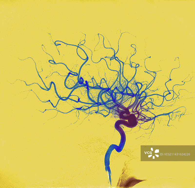 出血性中风损伤MRA扫描图片素材