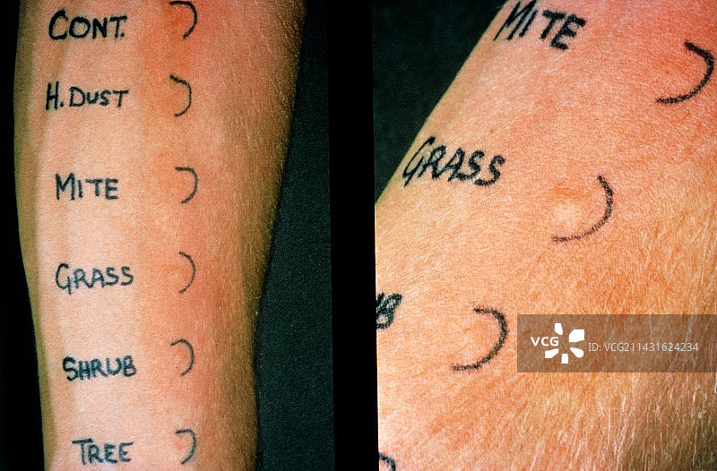 哮喘过敏皮肤测试图片素材