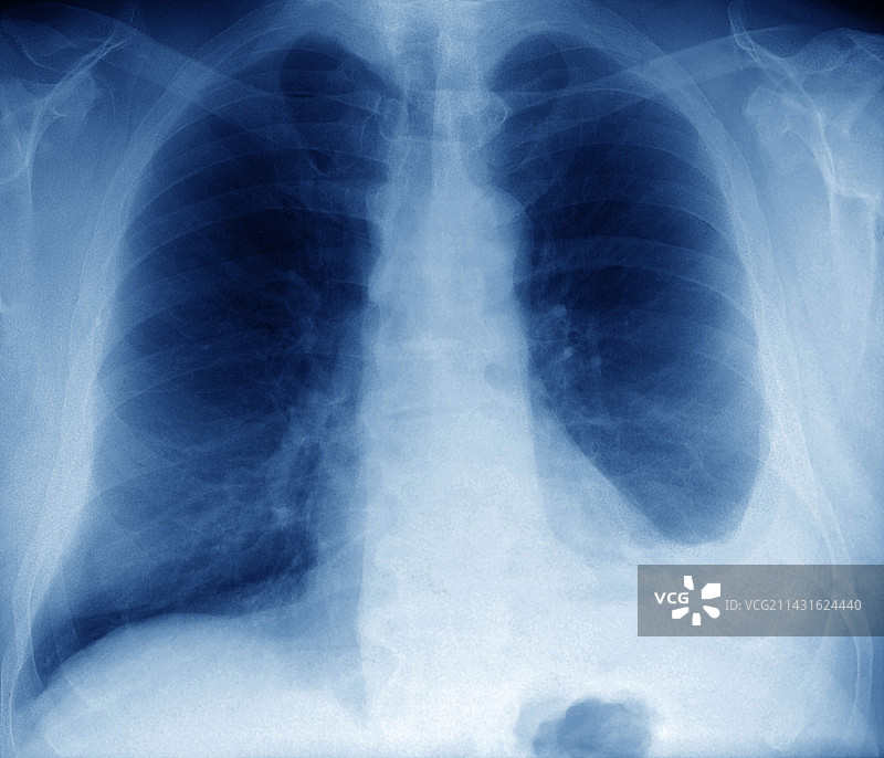 胸腔积液X光片图片素材