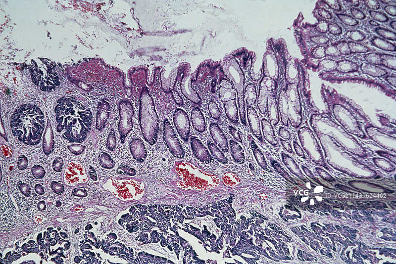 人结肠腺癌的LM显示图片素材