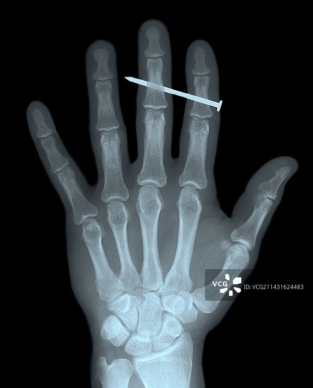 手指里的钉子X光片图片素材