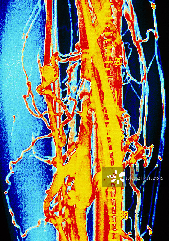 患者腿部静脉炎的彩色静脉造影图片素材
