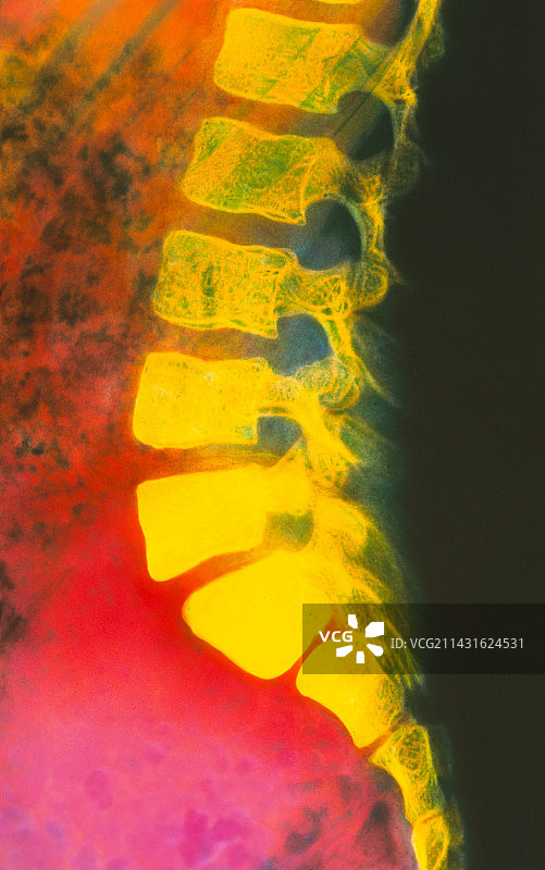 脊椎前移的彩色X光片图片素材