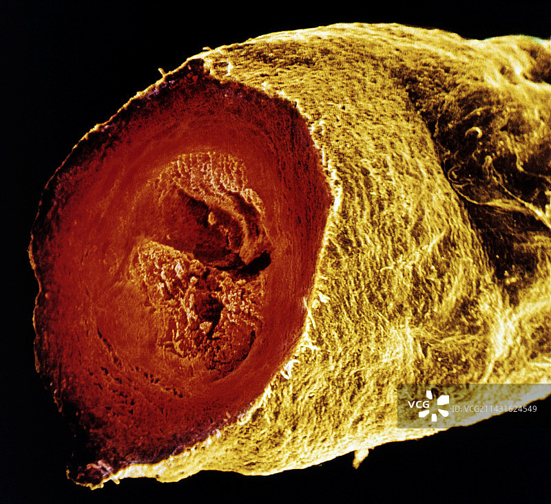 曲张的大隐静脉切面的彩色扫描电镜图图片素材