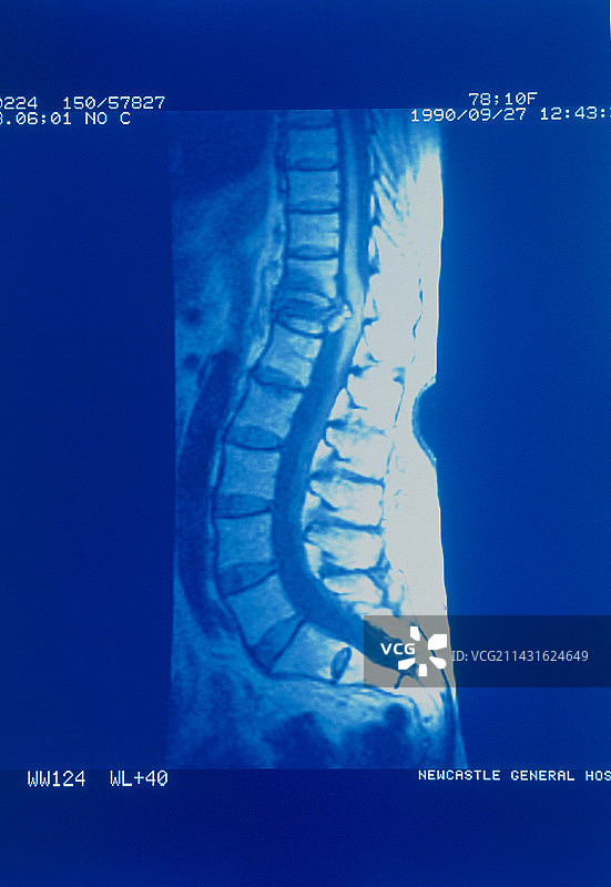 骨质疏松症女性脊柱的MRI扫描图片素材