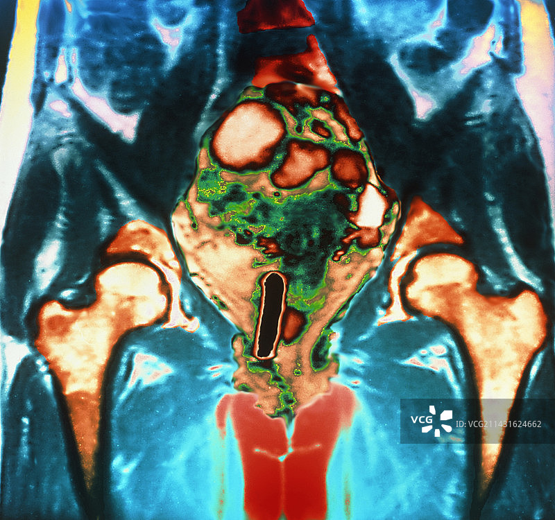 卵巢癌核磁共振成像图片素材