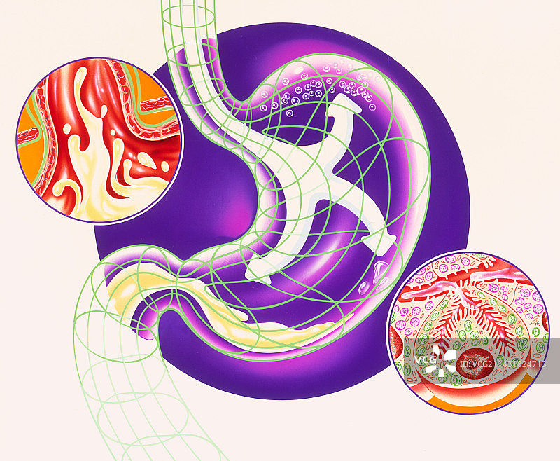 显示消化不良和胃酸倒流治疗的艺术作品图片素材