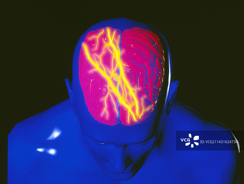 带闪电的大脑：头痛或癫痫图片素材