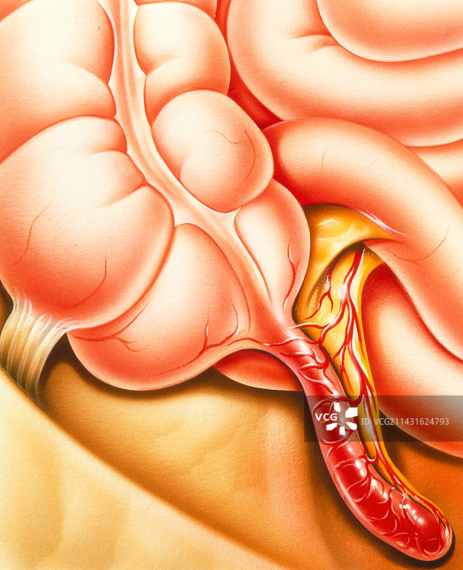 患有阑尾炎的阑尾艺术作品图片素材